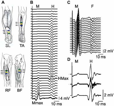 Characterization of Involuntary Contractions after Spinal Cord Injury Reveals Associations between Physiological and Self-Reported Measures of Spasticity